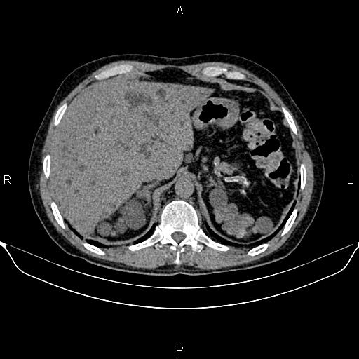 Autosomal dominant polycystic kidney disease (Radiopaedia 87830-104287 Axial non-contrast 13).jpg
