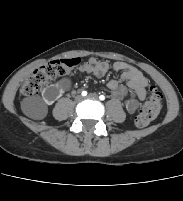 Autosomal dominant polycystic kidney disease - early onset (Radiopaedia 40734-43387 B 50).jpg