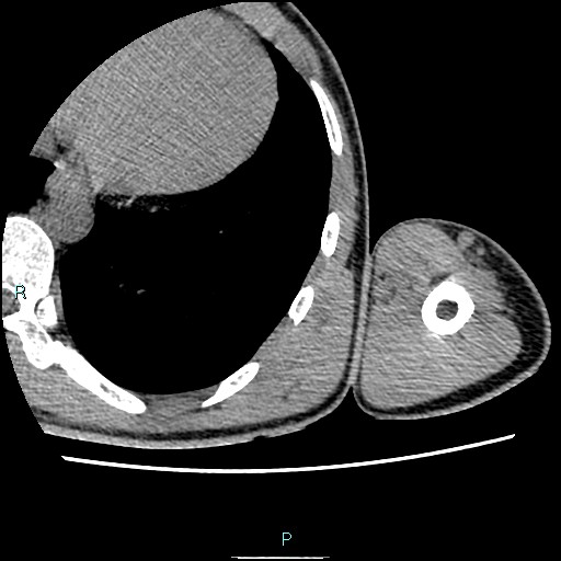 File:Avascular necrosis after fracture dislocations of the proximal humerus (Radiopaedia 88078-104653 D 107).jpg
