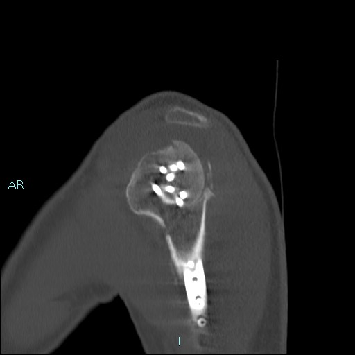Avascular necrosis after fracture dislocations of the proximal humerus (Radiopaedia 88078-104653 Sagittal bone window 20).jpg
