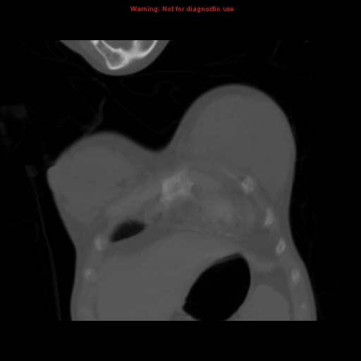 File:Avascular necrosis in sickle cell disease (Radiopaedia 17448-17152 Coronal bone window 13).jpg