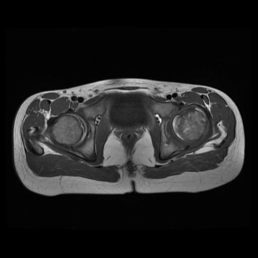 File:Avascular necrosis of the hip (Radiopaedia 29563-30067 Axial T1 9).jpg