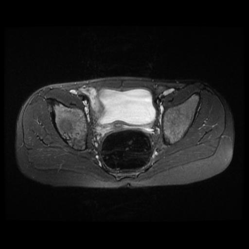 File:Avascular necrosis of the hip (Radiopaedia 29563-30067 Axial T2 fat sat 2).jpg