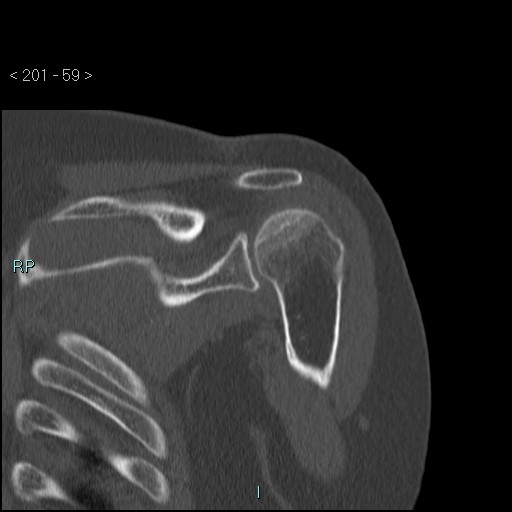 Avascular necrosis of the shoulder - Cruess stage I (Radiopaedia 77674-89887 Coronal bone window 58).jpg