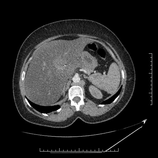 File:Azygos continuation of the IVC (Radiopaedia 40416-42965 A 22).jpg