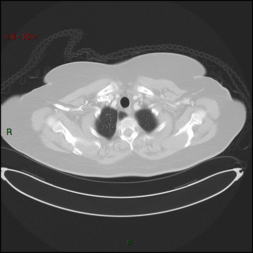 Azygos fissure and lobe (Radiopaedia 47620-52278 Axial lung window 10).jpg