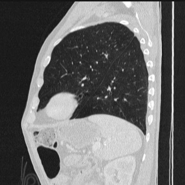Azygos lobe (Radiopaedia 38259-40275 lung window 76).jpg