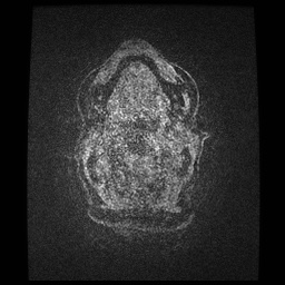 Balo concentric sclerosis (Radiopaedia 53875-59982 Axial LAVA C+ 276).jpg