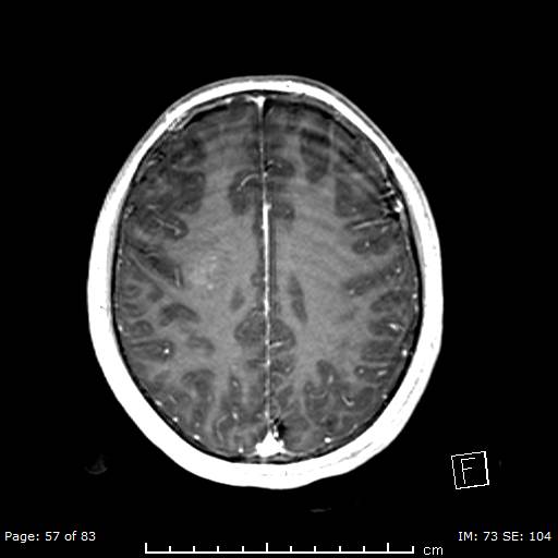 Balo concentric sclerosis (Radiopaedia 61637-69636 Axial T1 C+ 57).jpg