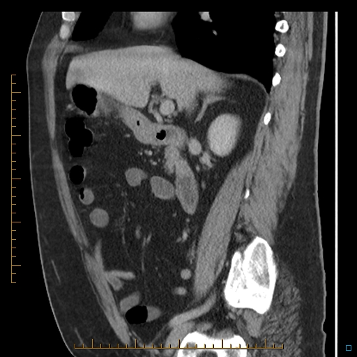 Bariatric balloon causing gastric outlet obstruction (Radiopaedia 54449-60672 C 51).jpg