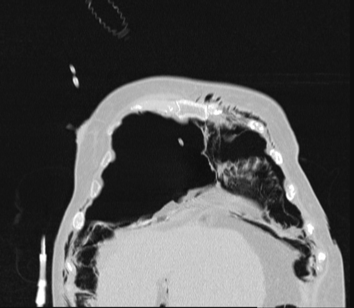 Barotrauma due to mechanical ventilation (Radiopaedia 28079-28336 Coronal lung window 18).jpg