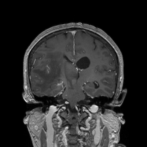 Basal ganglia metastasis (Radiopaedia 78928-91828 Coronal T1 C+ 10).png