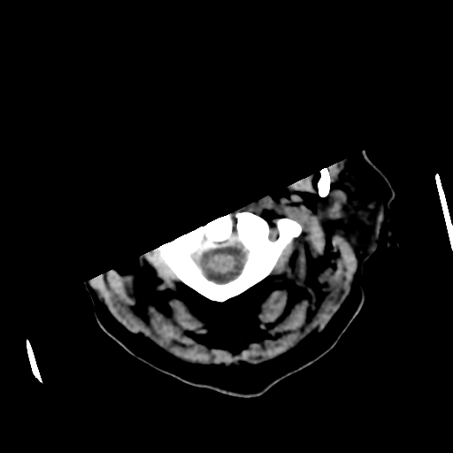 Basal ganglia metastasis (Radiopaedia 78928-91830 Axial non-contrast 7).png