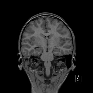 Base of skull rhabdomyosarcoma (Radiopaedia 32196-33142 Coronal T1 25).jpg