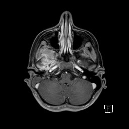 Base of skull rhabdomyosarcoma (Radiopaedia 32196-33142 T1 C+ fat sat 28).jpg
