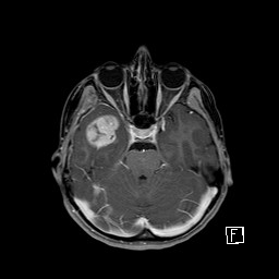 Base of skull rhabdomyosarcoma (Radiopaedia 32196-33142 T1 C+ fat sat 35).jpg