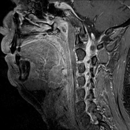 Base of tongue squamous cell carcinoma (Radiopaedia 31174-31884 F 74).jpg