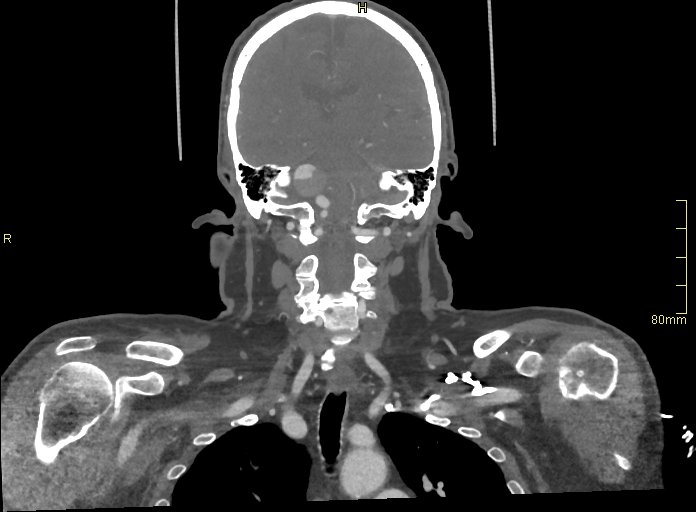 Basilar artery aneurysm (Radiopaedia 56261-62932 B 35).jpg