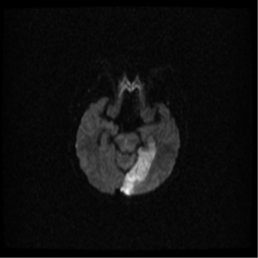 Basilar artery occlusion (Radiopaedia 33570-34667 Axial DWI 15).png