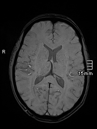 Basilar artery perforator aneurysm (Radiopaedia 82455-99523 Axial SWI 37).jpg