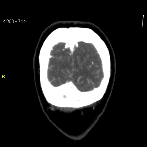 Basilar artery thrombosis (Radiopaedia 16260-15944 B 65).jpg