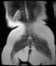 File:Beckwith-Wiedeman syndrome with bilateral Wilms tumors (Radiopaedia 60850-69233 Coronal T2 15).jpg