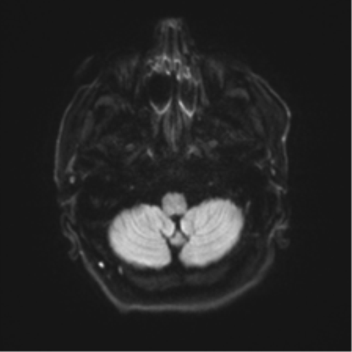 File:Behavioral variant frontotemporal dementia and late onset schizophrenia (Radiopaedia 52197-58083 Axial DTI Trace W 31).png