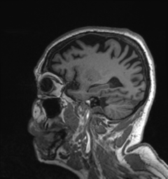 File:Behavioral variant frontotemporal dementia and late onset schizophrenia (Radiopaedia 52197-58083 Sagittal T1 20).png