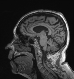 Behavioral variant frontotemporal dementia and late onset schizophrenia (Radiopaedia 52197-58083 Sagittal T1 55).png