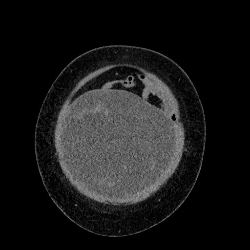 Benign leiomyoma with hydropic features (Radiopaedia 89250-106130 B 18).jpg