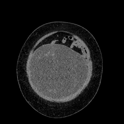 File:Benign leiomyoma with hydropic features (Radiopaedia 89250-106130 B 19).jpg