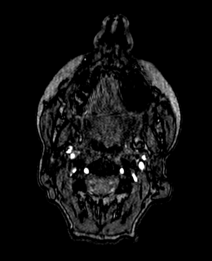 Berry aneurysm of the terminal internal carotid artery (Radiopaedia 88286-104918 Axial TOF 1).jpg