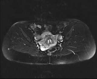 File:Bicornuate bicollis uterus (Radiopaedia 61626-69616 Axial PD fat sat 18).jpg