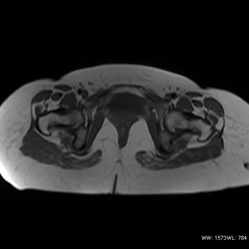 File:Bicornuate uterus- on MRI (Radiopaedia 49206-54297 Axial T1 14).jpg