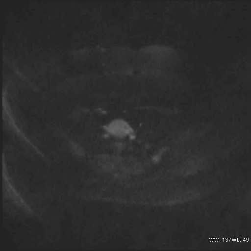 File:Bicornuate uterus (MRI) (Radiopaedia 49206-54297 Axial 116).jpg