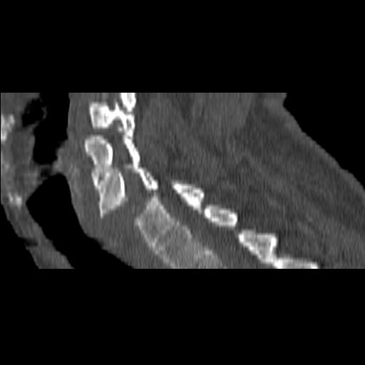 File:Bilateral C6-7 locked facet dislocation (Radiopaedia 28506-28748 Sagittal bone window 13).jpeg