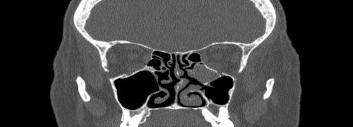 Bilateral Ectopic Infraorbital Nerves (Radiopaedia 49006-54084 Coronal bone window 40).jpg