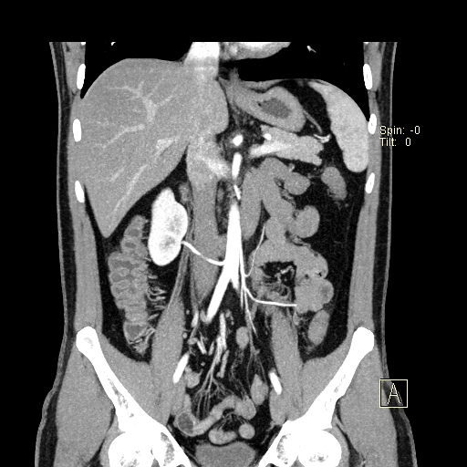File:Bilateral accessory renal arteries with mild pelvi-ureteric junction (PUJ) obstruction (Radiopaedia 66357-75596 B 14).jpg