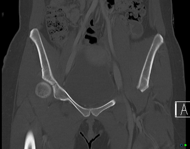 File:Bilateral acetabular fractures (Radiopaedia 79272-92308 Coronal bone window 11).jpg
