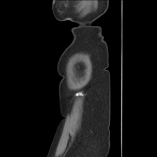 File:Bilateral adrenal granulocytic sarcomas (chloromas) (Radiopaedia 78375-91007 C 129).jpg