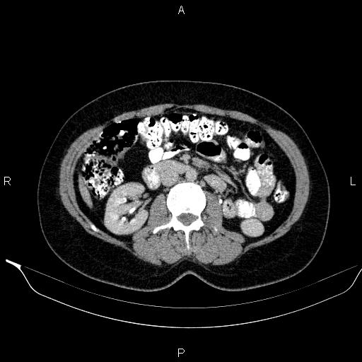 Bilateral adrenal myelolipoma (Radiopaedia 63058-71535 Axial C+ delayed 62).jpg
