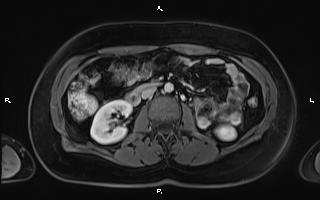 Bilateral adrenal myelolipoma (Radiopaedia 63058-71537 G 55).jpg