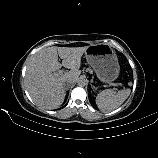 Bilateral benign adrenal adenomas (Radiopaedia 86912-103124 Axial non-contrast 30).jpg