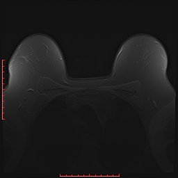 File:Bilateral breast implant rupture (Radiopaedia 24761-25027 PASTA 2).jpg