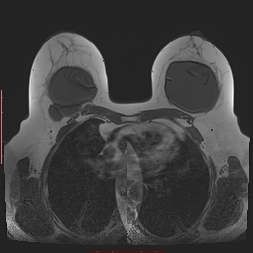 File:Bilateral breast implant rupture (Radiopaedia 24761-25027 T1 17).jpg