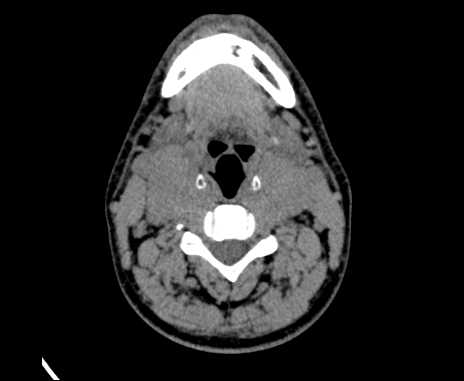 Bilateral carotid body tumors (Radiopaedia 61841-69870 Axial non-contrast 50).jpg
