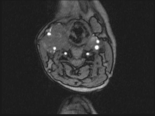 Bilateral carotid body tumors and right glomus jugulare tumor (Radiopaedia 20024-20060 Axial MRA 250).jpg
