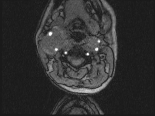 Bilateral carotid body tumors and right glomus jugulare tumor (Radiopaedia 20024-20060 Axial MRA 258).jpg