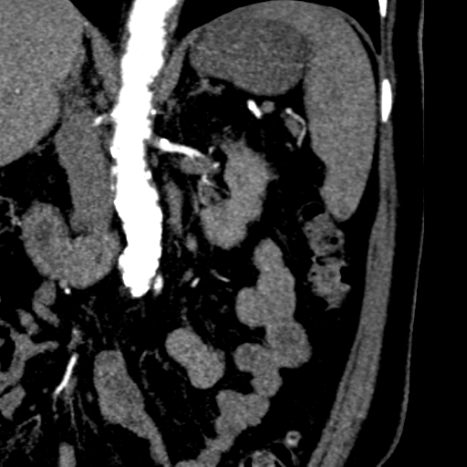 File:Bilateral delayed nephrogram from renal artery stenosis (Radiopaedia 47681-52362 B 8).png