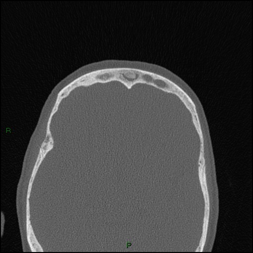 Bilateral frontal mucoceles (Radiopaedia 82352-96454 Axial bone window 84).jpg